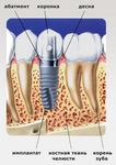 Хирургическая стоматология: Имплантация зубов