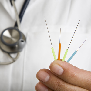 Иглоукалывание