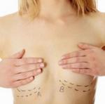 Пластическая хирургия: Уменьшение груди