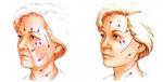 Пластическая хирургия: Подтяжка лица и шеи (лифтинг)