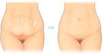 Пластическая хирургия: Абдоминопластика