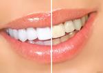 Стоматология: отбеливание зубов