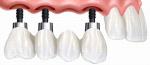 Хирургическая стоматология: протезирование на имплантах (съемное и несъемное, временные протезы)