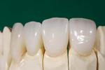 Ортопедическая стоматология (протезирование зубов): Безметалловая керамика