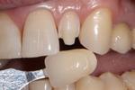 Ортопедическая стоматология (протезирование зубов): Изготовление виниров