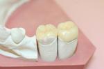 Ортопедическая стоматология (протезирование зубов): Изготовление керамических вкладок