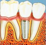 Ортопедическая стоматология (протезирование зубов): Протезирование с опорой на имплантах