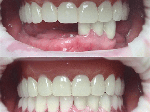 Удаление зуба (сложное) - услуги стоматолога