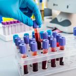 Биохимический анализ крови: Глюкоза - лабораторное исследование