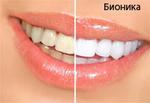 Отбеливание зубов, удаление налета с зубов - услуги стоматолога