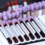 Общий анализ крови - лабораторные исследования
